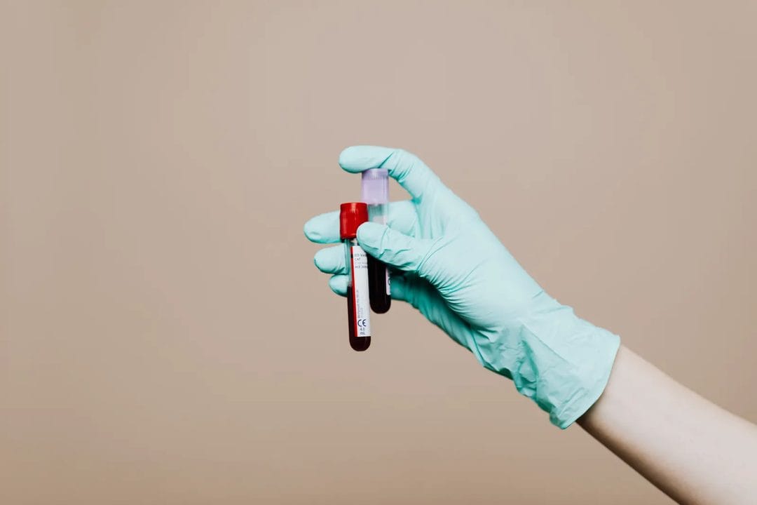 Iron Deficiency Without Anaemia: The Fatigue ‘Normal’ Blood Tests Miss